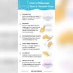 How to Massage C Section Scar