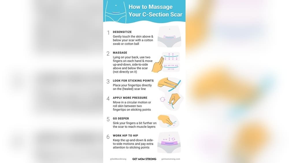 How to Massage C Section Scar