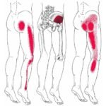 Where to Massage for Sciatica