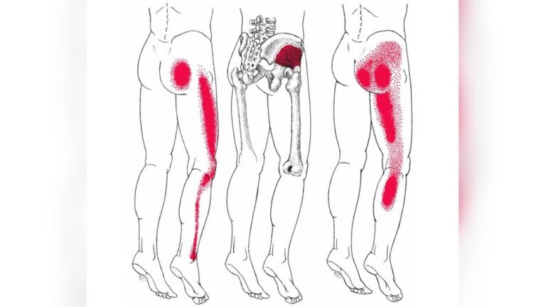 Where to Massage for Sciatica