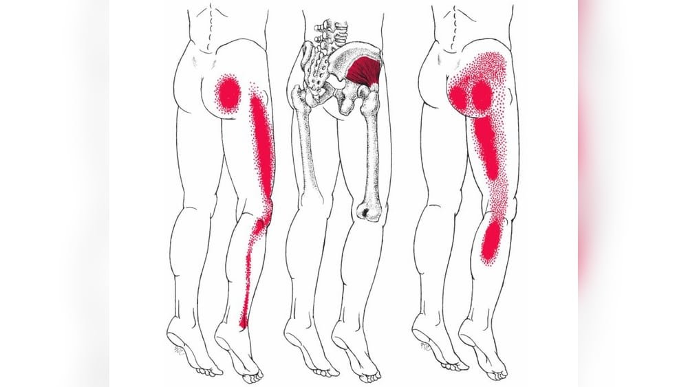 Where to Massage for Sciatica